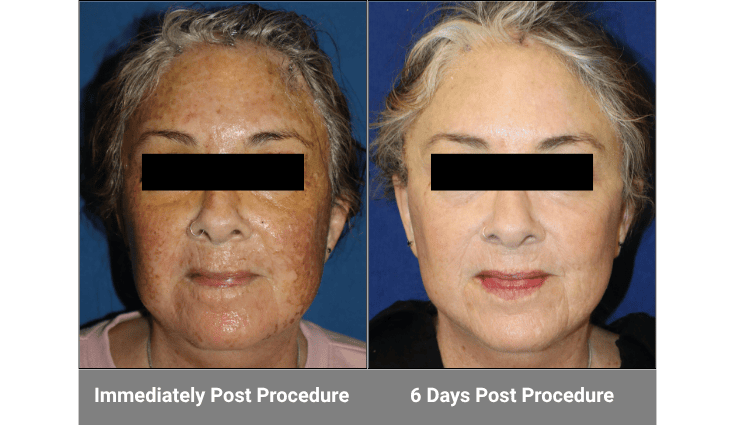 DefenAge Pro 5+ Defensin Recovery Serum