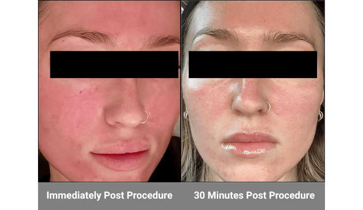 DefenAge Pro 5+ Defensin Recovery Serum
