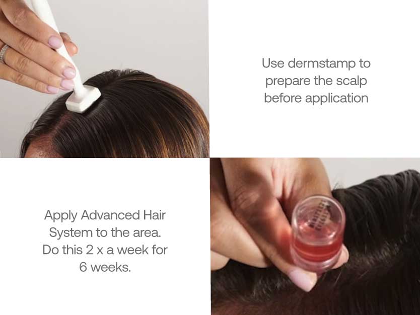 Calecim Advanced Hair System