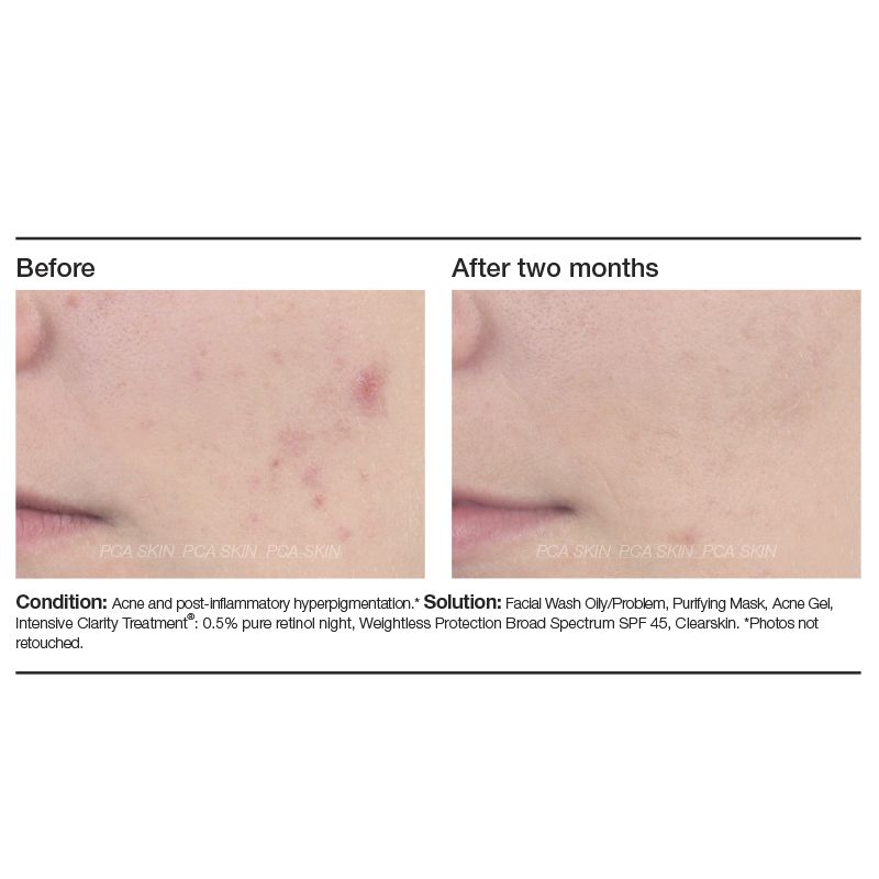 PCA Skin Acne Gel Advanced Treatment