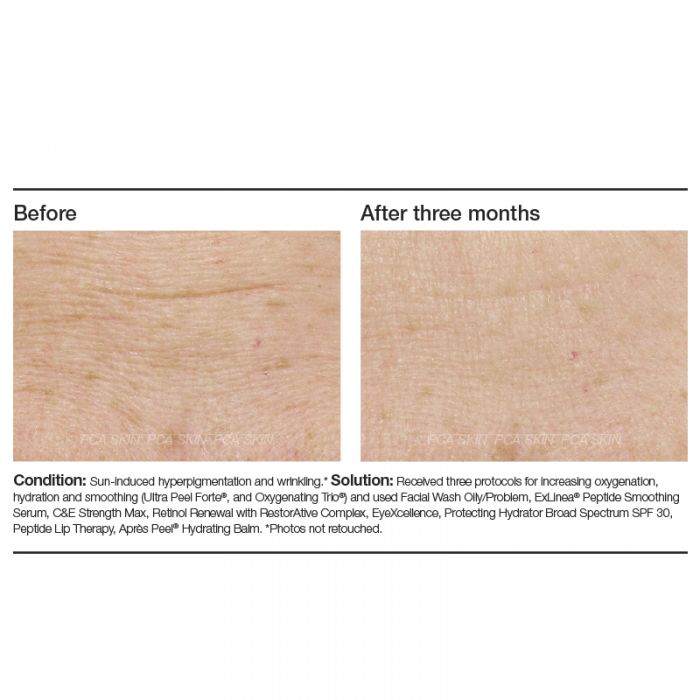 PCA Skin ExLinea® Peptide Smoothing Serum