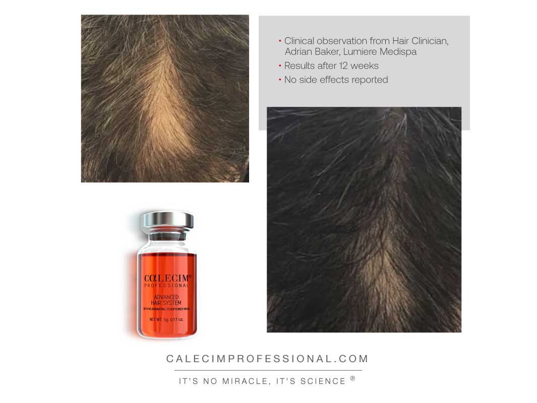 Calecim Advanced Hair System