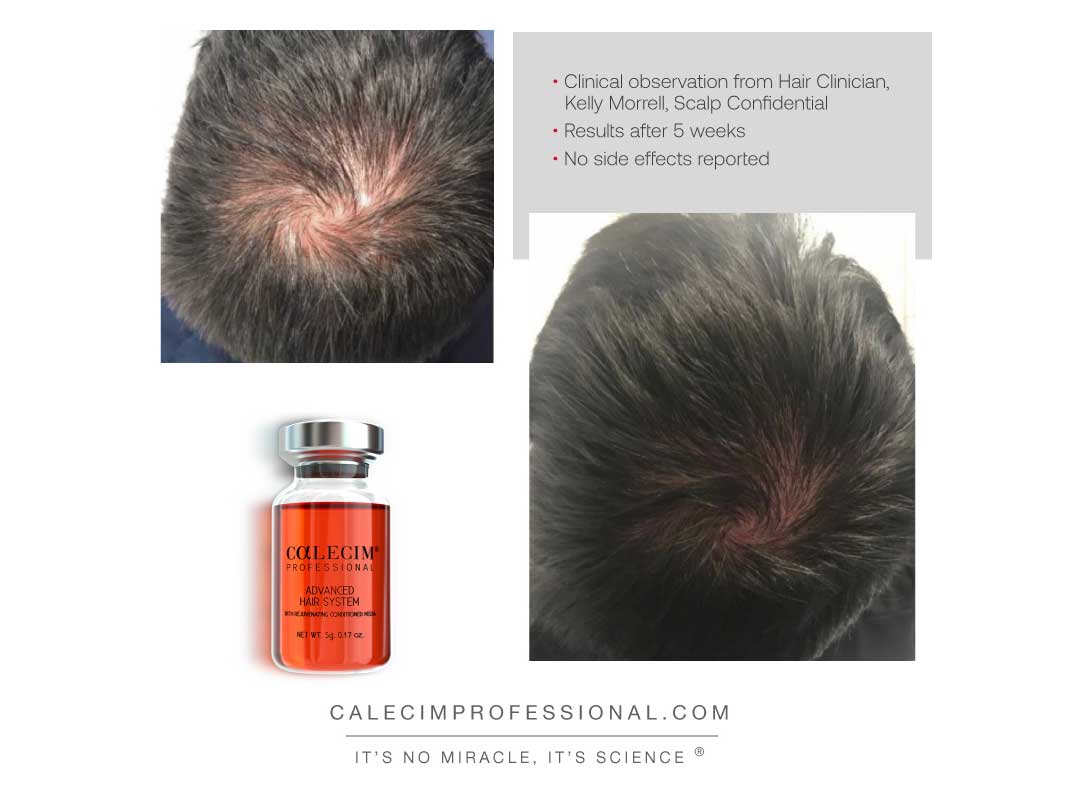 Calecim Advanced Hair System