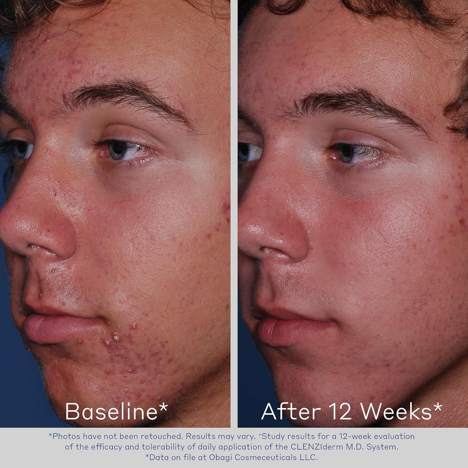 Obagi CLENZIderm M.D. Pore Therapy | skinBEAUTIFUL RX