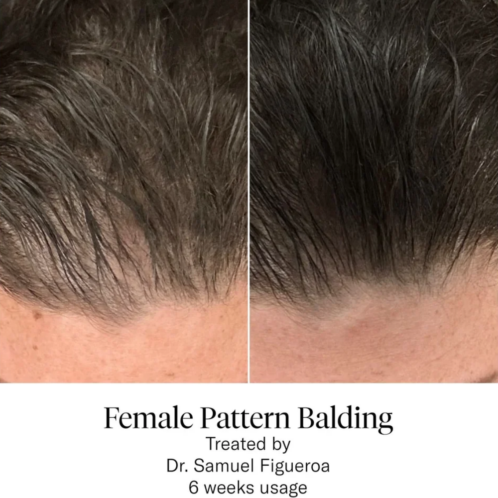 Calecim HAIR Serum