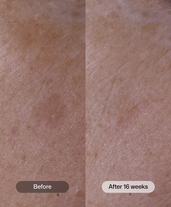 Revision Skincare Advanced Pigment Corrector+ ™