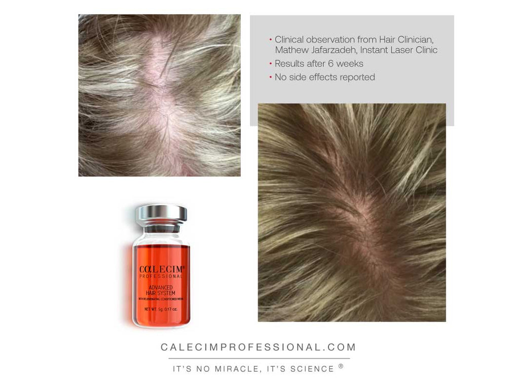 Calecim Advanced Hair System